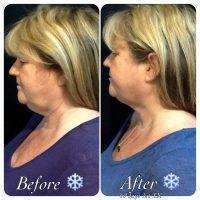 Before And After Coolsculpting Of Neck