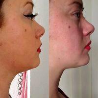 Best Non Invasive Fat Removal From Chin With Dr Jason D. Bloom, Philadelphia Plastic Surgeon