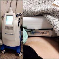CoolSculpting Is A Non-invasive Treatment That Can Reduce Unwanted Fat