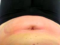 CoolSculpting Utilizes Cold Temperatures To Target And Damage Fat Cells