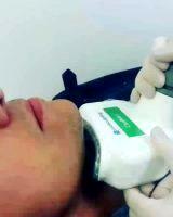 Coolsculpting Chin Procedure Photo