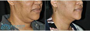 Dr Sonnie Kim-Ashchi, MD, Jacksonville OB-GYN - 49 Year Old Woman Treated With Coolsculpting Neck Chin