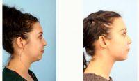 Dr. Andrew T. Lyos, MD, FACS, Houston Plastic Surgeon - 39 Year Old Woman Treated With CoolSculpting NEck