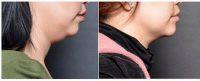 Freezing Fat Off Neck At New Orleans Center For Aesthetics And Plastic Surgery