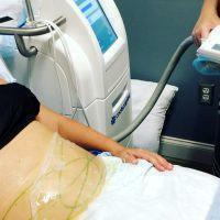 How To Choose A Coolsculpting Clinic