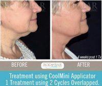 Neck Coolsculpting Using Coolmini Applicator