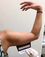 Now, CoolSculpting For Your Arms Is An Option, Too