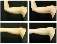 Results After Coolsculpting On Arms