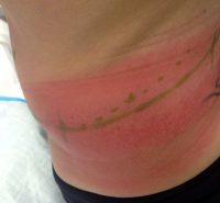 Swelling And Inflammation After CoolSculpting Is Not Uncommon