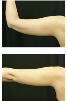 The Saggy Flab Of Upper Arms