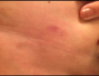 The Swelling After Coolsculpting Decreased Over The Next Week And The Sensitivity Decreased As Well