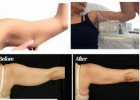 Zeltiq Coolsculpting For Arm Fat