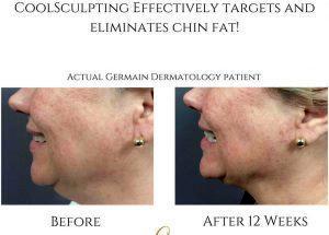 12 Weeks After Coolsculpting For Chin
