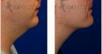 26 Year Old Man Treated With Kybella With Doctor Jordan Cain, MD, Frisco Facial Plastic Surgeon