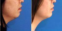 29 Year Old Woman Treated With One Kybella Session With Dr. Richard W. Westreich, MD, Manhattan Facial Plastic Surgeon