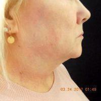 62 Year Old Patients Treated With CoolSculpting Of Chin