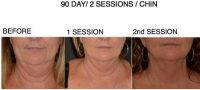90 Days Post 2nd Session Coolsculpting