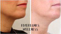 Before And After Coolsculpting Double-Chin Treatment