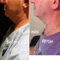 Cool Mini Before And After By Dr. Kurtis Martin, Cincinnati Plastic Surgeon