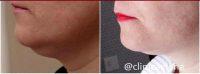 Coolmini Coolsculpting Before After Results