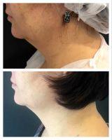 Coolmini Double Chin Pre And Post Treatment