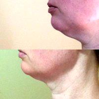 Doctor Michael Glass, Reno Plastic Surgeon Freeze Fat Removal From Chin