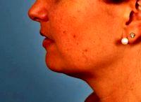 Dr Thomas Hubbard, MD, FACS, Virginia Beach Plastic Surgeon - 41 Year Old Woman Treated With CoolSculpting Chin