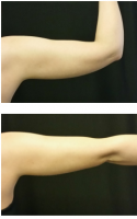 Pre And Post Coolsculpting Under Arm