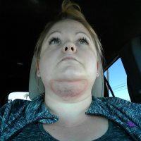 Swelling After Coolsculpting Chin