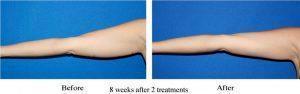 8 Weeks After 2 Treatments Coolsculpting For Arms By John Lundeby, MD, FACS, FAACS In Spokane, Washington