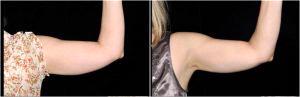 Arm Coolsculpting At At Premier Plastic Surgery, Plastic Surgery Clinic In Upper St. Clair, Pennsylvania