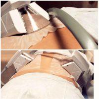 CoolSculpting Of The Bra Roll And Upper Back Fat