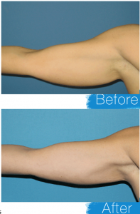 Coolsculpting Arms By Dr. Kevin Johnson In Spokane, WA