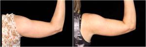 Coolsculpting For Arms At Premier Plastic Surgery, Plastic Surgery Clinic In Upper St. Clair, Pennsylvania