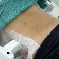 Coolsculpting For Slim Hips