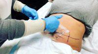 Cryogenic Lipolysis Is Permanent, Non-invasive, And Requiring No Recovery Time