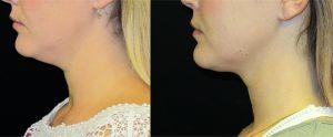 Chin Coolsculpting By Dr. Kramer, Boise Plastic Surgeon