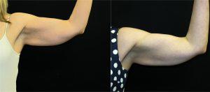 Coolsculpting Bilateral Arms By Dr. Kramer, Boise Plastic Surgeon