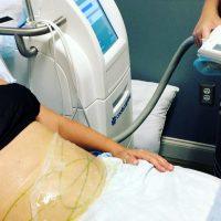 Cryo Freezing Fat Cells Permanently Destroys And Removes 25% Of Fat Cells In One Session
