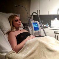 Cryo Liposuction To Upper Abs