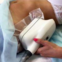 Cryolipolysis Treatment With Cocoon