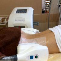 Frozen Fat Removal With Cocoon