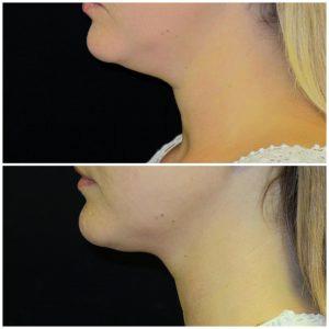 One Session Using 2 Coolmini Applicators By Dr. Jonathan Kramer, Plastic Surgeon In Meridian, ID