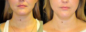 Submental Fat Before And After By Dr. Kramer, Boise Plastic Surgeon