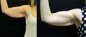 Two Applicators Each Arm For A Total Of 4 Applicators In One Session By Dr. Kramer, Boise Plastic Surgeon