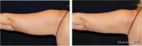 Doctor Michael Law, MD, Raleigh-Durham Plastic Surgeon - 49 Year Old Woman Treated With CoolSculpting
