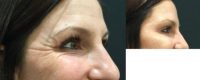 25-34 year old woman treated with Botox