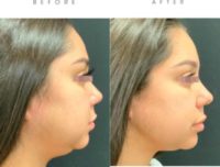 18-24 year old woman treated with Submental Liposuction