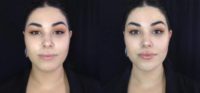 25-34 year old woman non-surgical chin and jaw augmentation