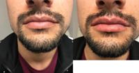 25-34 year old man treated with Juvederm to lips